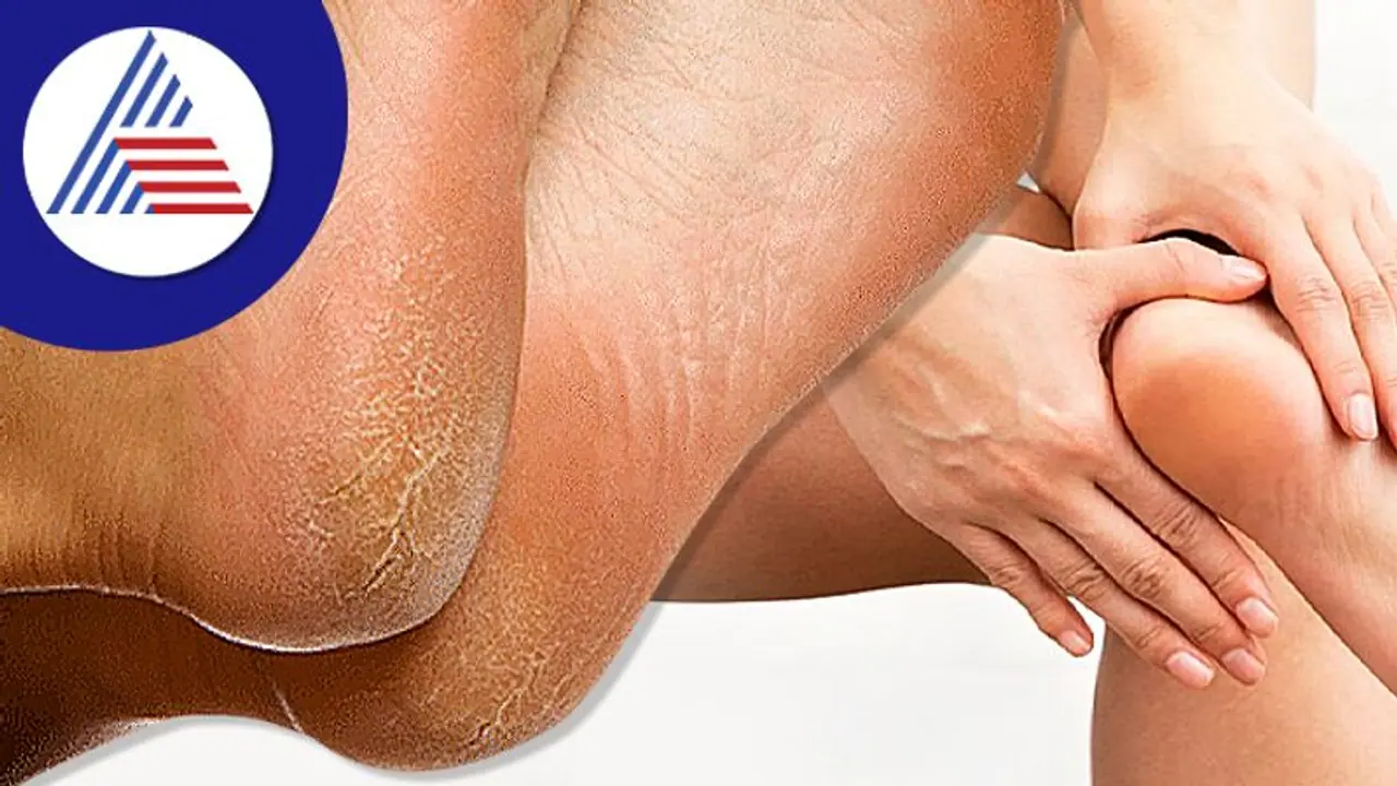 ಚಳಿಗಾಲದಲ್ಲಿ ಕಾಡೋ ಹಿಮ್ಮಡಿ ಒಡೆತ, ಹೀಗ್ ಮಾಡಿ ಮನೆ ಮದ್ದು ಚಳಿಗಾಲದಲ್ಲಿ ಕಾಡೋ ಹಿಮ್ಮಡಿ ಒಡೆತ, ಹೀಗ್ ಮಾಡಿ ಮನೆ ಮದ್ದು