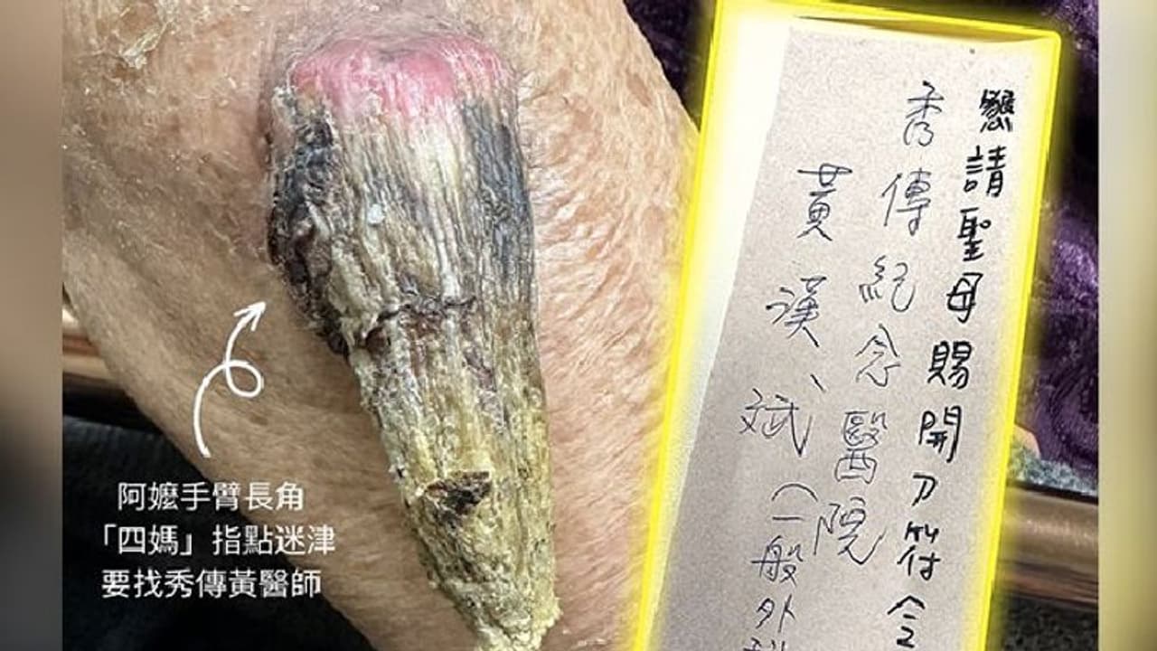 കയ്യില്‍ വളര്‍ന്ന 'കൊമ്പു'മായി ചികിത്സയ്ക്കെത്തിയ സ്ത്രീ!