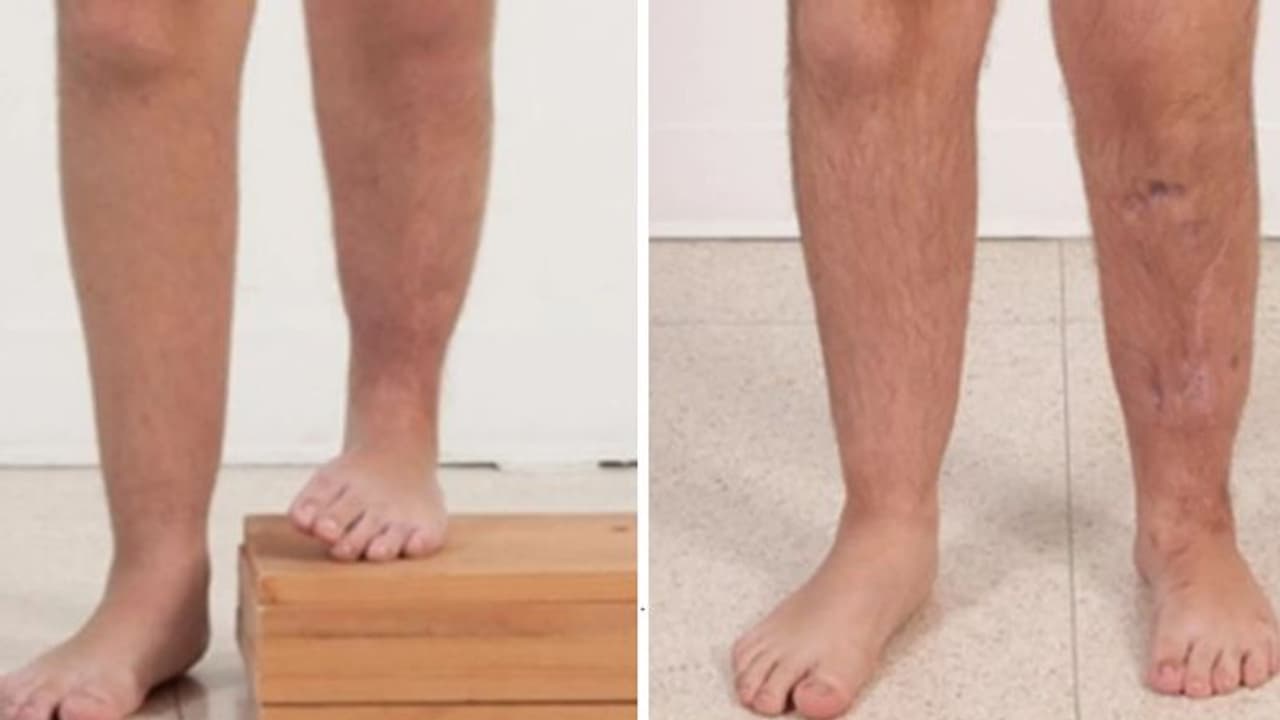 ഉയരം പോരെന്ന് അപകര്ഷത; തുടര്ന്ന് 1.2 കോടിയുടെ ശസ്ത്രക്രിയ നടത്തി ഉയരം പോരെന്ന് അപകര്ഷത; തുടര്ന്ന് 1.2 കോടിയുടെ ശസ്ത്രക്രിയ നടത്തി