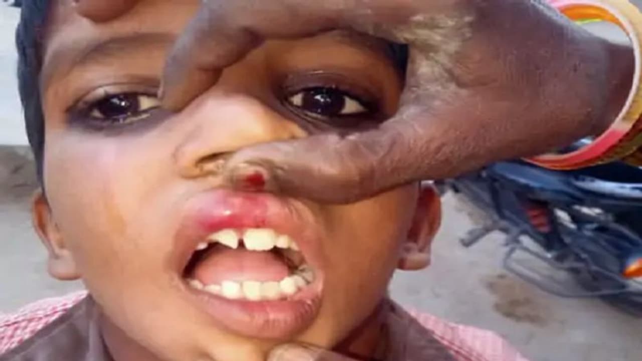 'न' ना बना पाने पर छात्र पर बर्बरता, शिक्षक ने पीट पीटकर तोड़ा दांत, नाक से आया खून 'न' ना बना पाने पर छात्र पर बर्बरता, शिक्षक ने पीट पीटकर तोड़ा दांत, नाक से आया खून