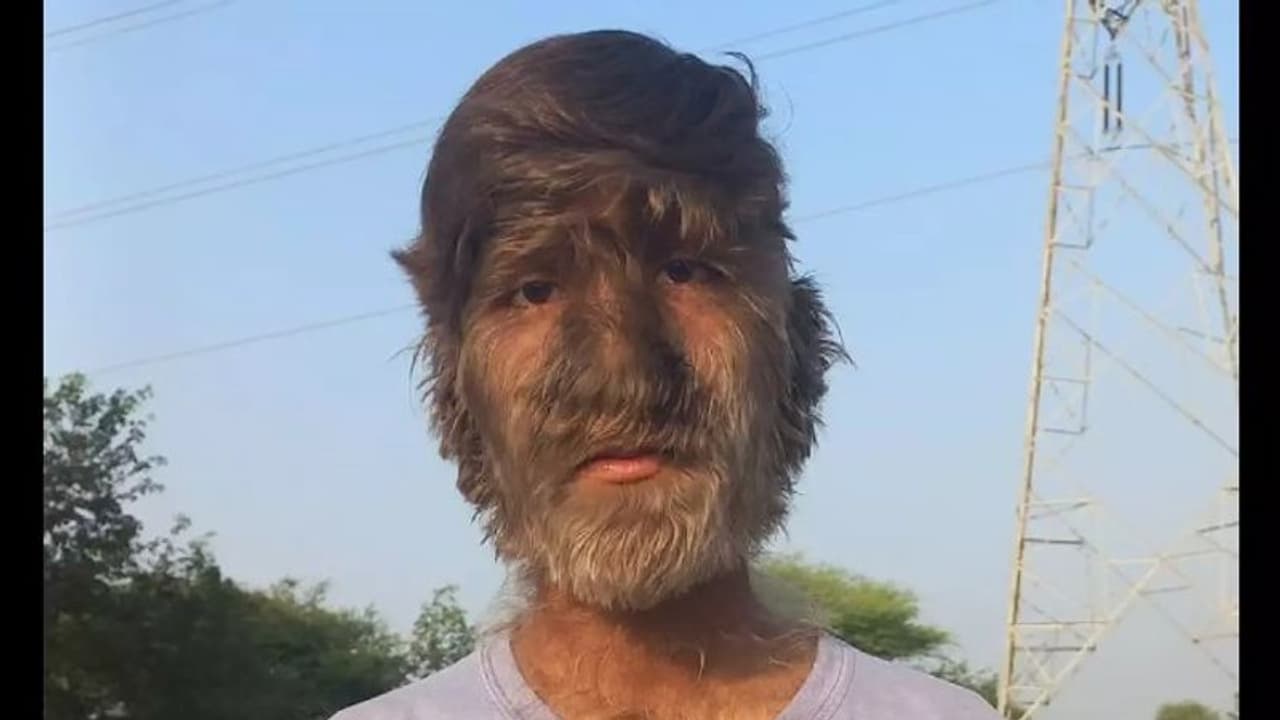 മുഖമടക്കം ശരീരം മുഴുവൻ രോമം; അപൂര്വങ്ങളില് അപൂര്വമായ രോഗവുമായി കൗമാരക്കാരൻ മുഖമടക്കം ശരീരം മുഴുവൻ രോമം; അപൂര്വങ്ങളില് അപൂര്വമായ രോഗവുമായി കൗമാരക്കാരൻ