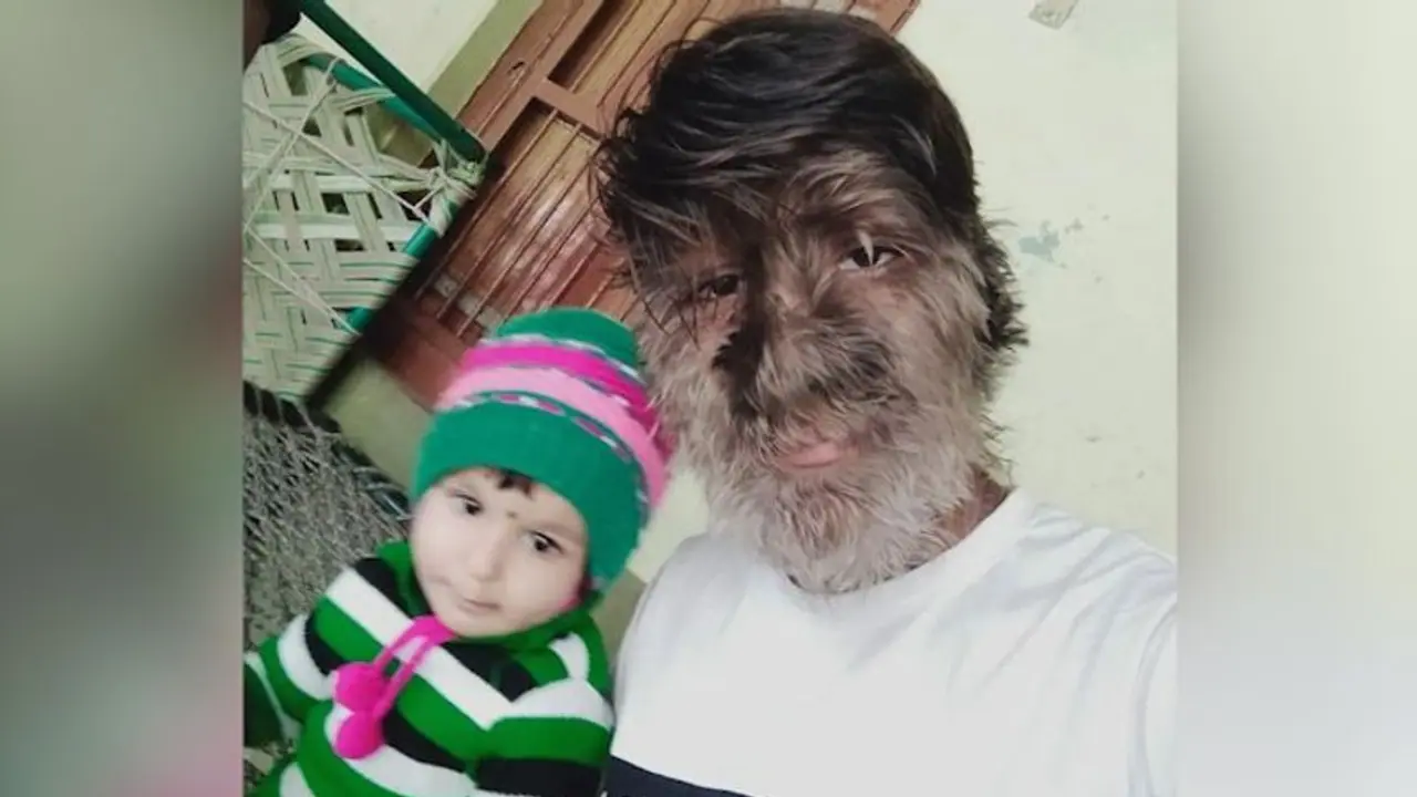MP boy diagnosed with rare 'werewolf syndrome'; Know about the disease with no cure