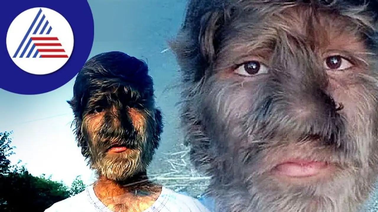 ಅಯ್ಯೋ ಪಾಪ...ಮುಖ, ಮೈ ಮೇಲೆಲ್ಲಾ ಕೂದಲು, ಇದು ವೆರ್ವುಲ್ಫ್ ಸಿಂಡ್ರೋಮ್ ! ಅಯ್ಯೋ ಪಾಪ...ಮುಖ, ಮೈ ಮೇಲೆಲ್ಲಾ ಕೂದಲು, ಇದು ವೆರ್ವುಲ್ಫ್ ಸಿಂಡ್ರೋಮ್ !