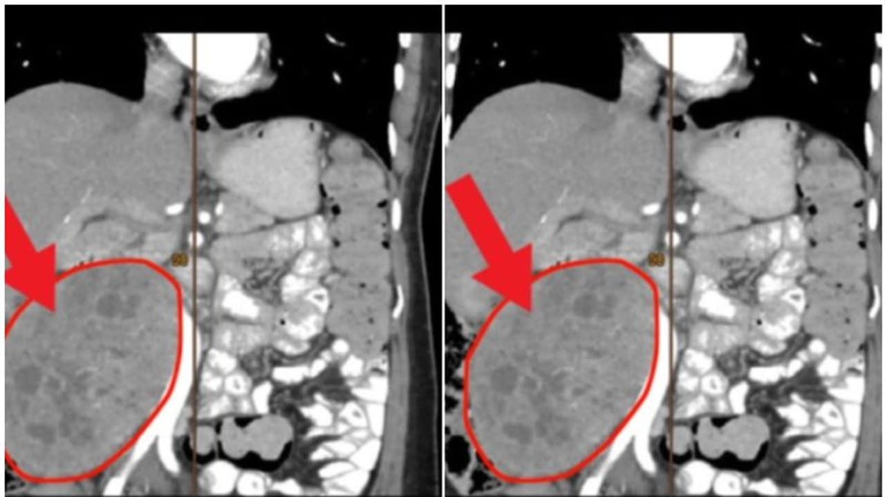 വയറുവേദനയുമായി ആശുപത്രിയിലെത്തി; 55കാരിയുടെ വയറ്റില് നിന്ന് നീക്കം ചെയ്തത് രണ്ട് കിലോ ഭാരമുള്ള മുഴ വയറുവേദനയുമായി ആശുപത്രിയിലെത്തി; 55കാരിയുടെ വയറ്റില് നിന്ന് നീക്കം ചെയ്തത് രണ്ട് കിലോ ഭാരമുള്ള മുഴ