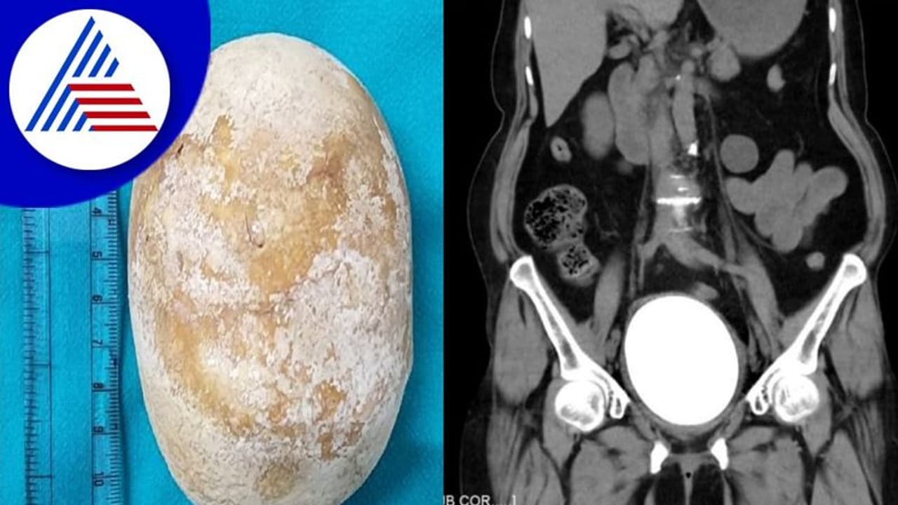 Udupi: ಮಹಿಳೆಯ ದೇಹದಿಂದ ವಿಶ್ವದ ಅತಿ ದೊಡ್ಡ ಕಿಡ್ನಿ ಸ್ಟೋನ್ ಹೊರ ತೆಗೆದ ಮಣಿಪಾಲದ ವೈದ್ಯರು