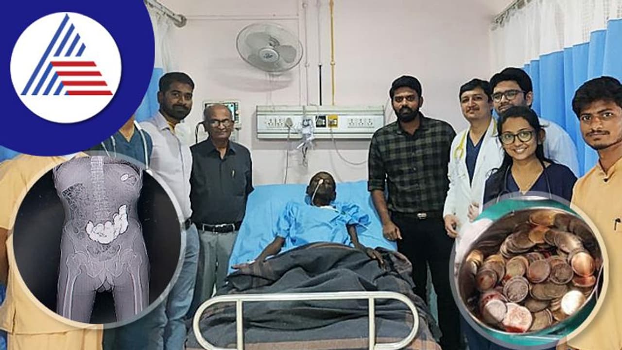 ಯಶಸ್ವಿ ಚಿಕಿತ್ಸೆ: ವೃದ್ಧನ ಹೊಟ್ಟೆಯಿಂದ 187 ನಾಣ್ಯ ಹೊರತೆಗೆದ ವೈದ್ಯರು! ಯಶಸ್ವಿ ಚಿಕಿತ್ಸೆ: ವೃದ್ಧನ ಹೊಟ್ಟೆಯಿಂದ 187 ನಾಣ್ಯ ಹೊರತೆಗೆದ ವೈದ್ಯರು!