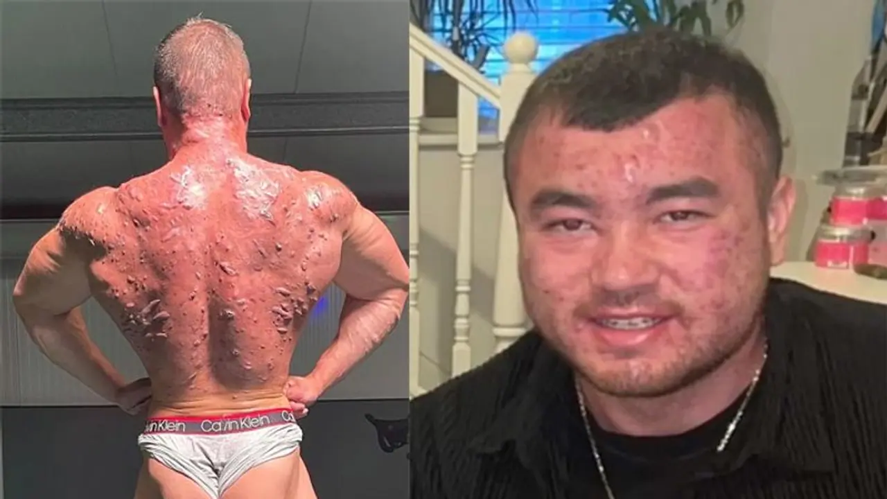 20 साल की उम्र से लेना शुरू किया स्टेरॉयड, अब हो गई ऐसी हालत की देख कर मुंह फेर लेते हैं लोग 20 साल की उम्र से लेना शुरू किया स्टेरॉयड, अब हो गई ऐसी हालत की देख कर मुंह फेर लेते हैं लोग