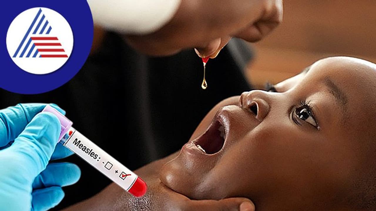 ಮುಂಬೈನಲ್ಲಿ ದಡಾರ ಕಾಯಿಲೆ ಉಲ್ಬಣ, 11 ಮಂದಿಗೆ ಸೋಂಕು, 1 ಶಂಕಿತ ಸಾವು ಮುಂಬೈನಲ್ಲಿ ದಡಾರ ಕಾಯಿಲೆ ಉಲ್ಬಣ, 11 ಮಂದಿಗೆ ಸೋಂಕು, 1 ಶಂಕಿತ ಸಾವು