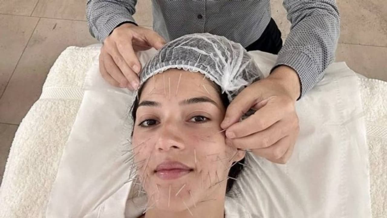 #Mehreen:మొహం నిండా సూదులు...బాలయ్య కోసమేనా?