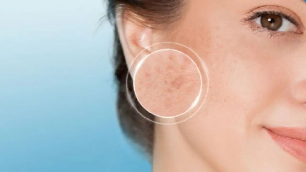 ഇവ ഉപയോഗിച്ചാല് മതി, മുഖത്തെ കറുത്ത പാടുകള് മാറ്റാം... ഇവ ഉപയോഗിച്ചാല് മതി, മുഖത്തെ കറുത്ത പാടുകള് മാറ്റാം...