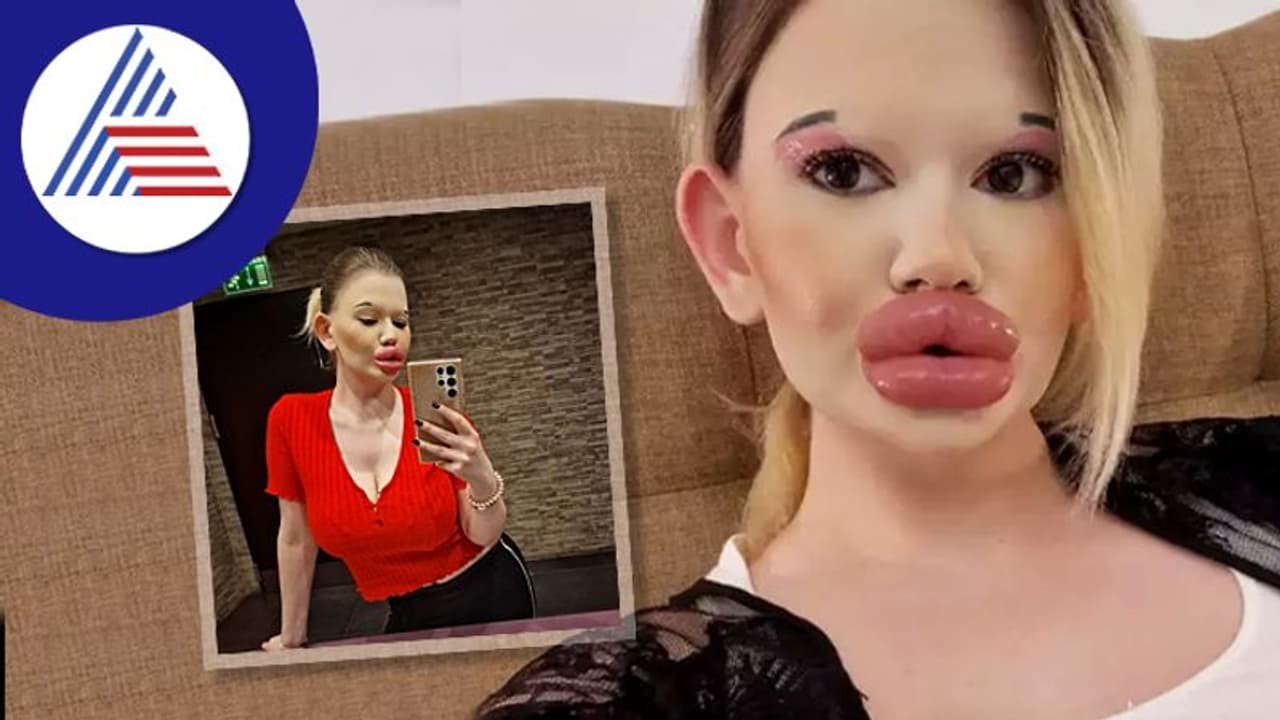 ಪ್ರಪಂಚದಲ್ಲೇ ಅತಿ ದೊಡ್ಡ ತುಟಿ ಹೊಂದಿರೋ ಮಹಿಳೆ, ಉಸಿರಾಡೋದು ಸಹ ಕಷ್ಟವಂತೆ !