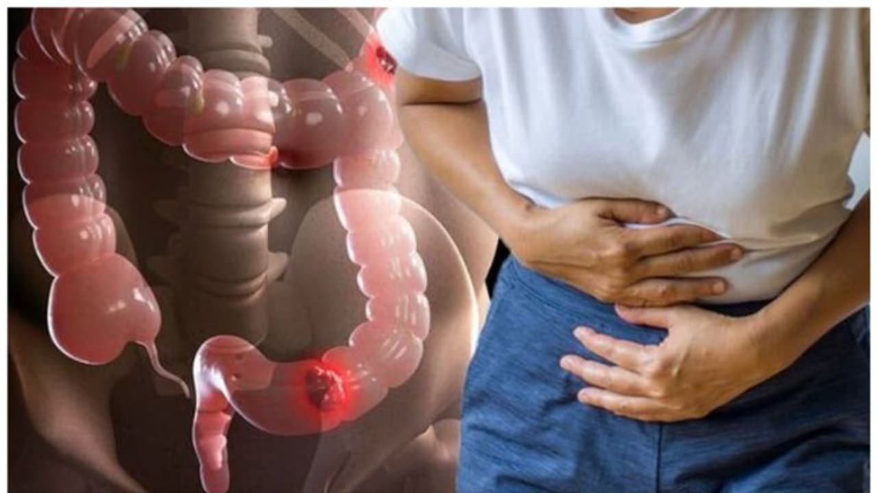 Bowel Cancer : കുടലിലെ ക്യാൻസർ ; ശ്രദ്ധിക്കണം ഈ ലക്ഷണം Bowel Cancer : കുടലിലെ ക്യാൻസർ ; ശ്രദ്ധിക്കണം ഈ ലക്ഷണം