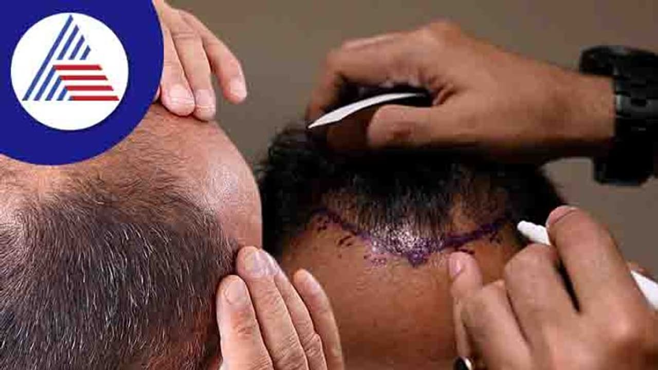 Man Dies Of Hair Transplant: ಕೂದಲು ಕಸಿ ಮಾಡಿಕೊಳ್ಳೋ ಮುನ್ನ ಇವಿಷ್ಟು ಗೊತ್ತಿರಲಿ Man Dies Of Hair Transplant: ಕೂದಲು ಕಸಿ ಮಾಡಿಕೊಳ್ಳೋ ಮುನ್ನ ಇವಿಷ್ಟು ಗೊತ್ತಿರಲಿ