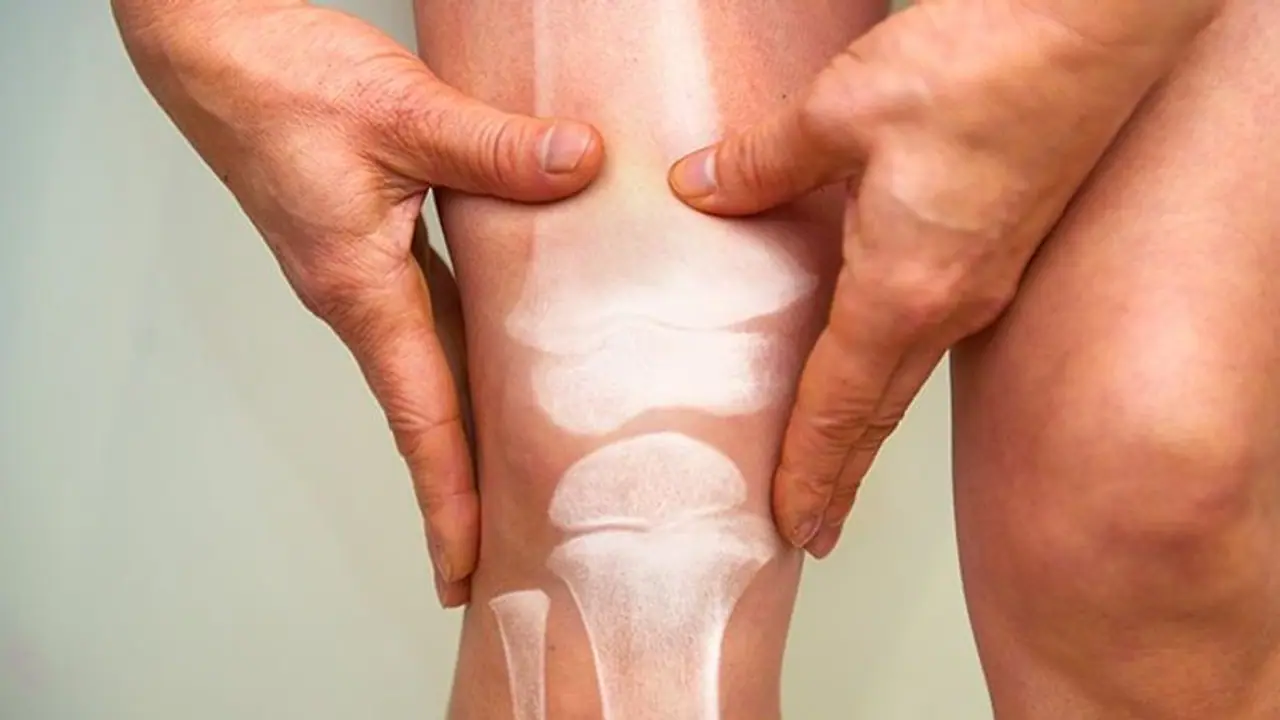 What is Stiff person syndrome? A glance at its causes and symptoms What is Stiff person syndrome? A glance at its causes and symptoms