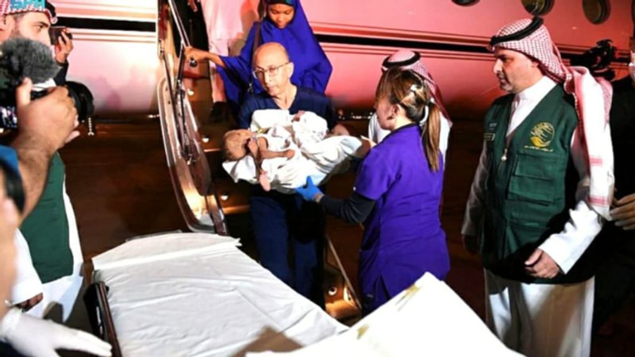 വേർപ്പെടുത്തൽ ശാസ്ത്രക്രിയക്കായി നൈജീരിയൻ സയാമീസ് ഇരട്ടകളെ റിയാദിലെത്തിച്ചു