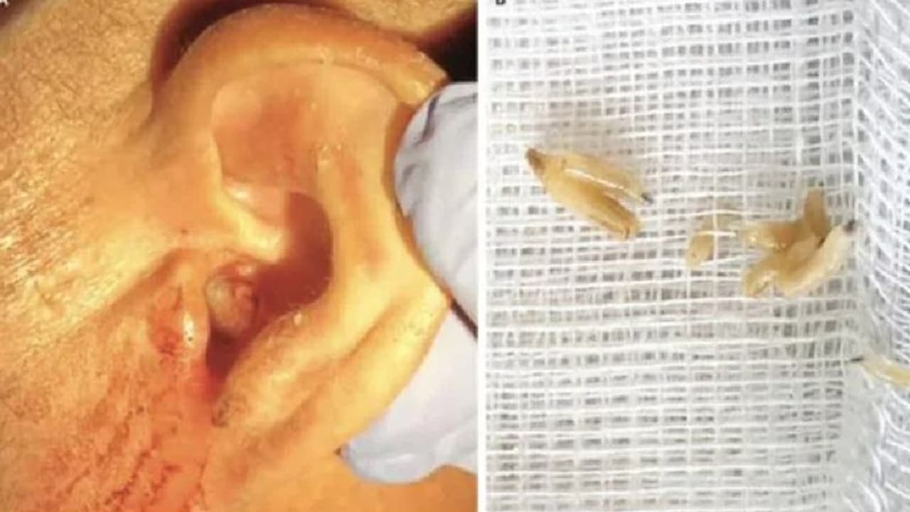 ಕಿವಿ ನೋವೆಂದು ಆಸ್ಪತ್ರೆಗೆ ಬಂದ ವೃದ್ಧನ ಕಿವಿ ನೋಡಿ ವೈದ್ಯರೇ ಕಂಗಾಲು 