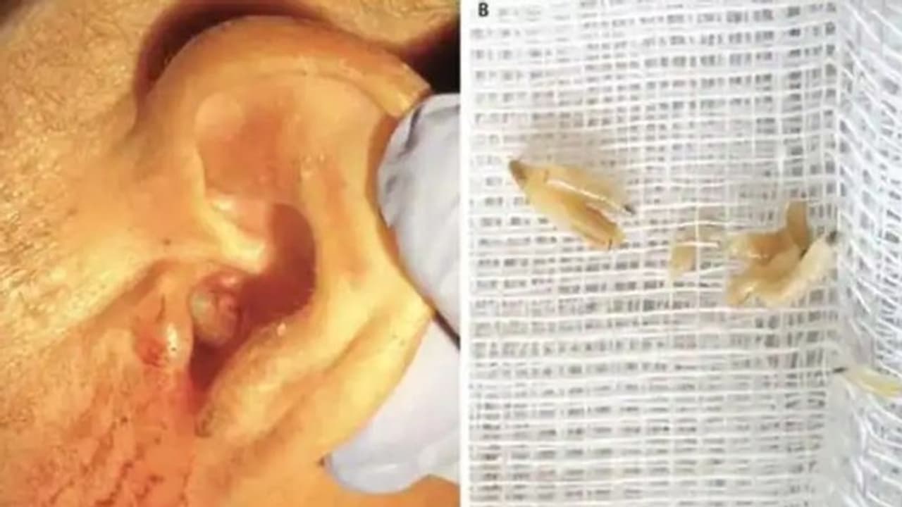 വേദനയും ചൊറിച്ചിലുമായി ആശുപത്രിയിലെത്തിയ രോഗിയുടെ ചെവിയില് നിന്ന് കണ്ടെത്തിയത്... വേദനയും ചൊറിച്ചിലുമായി ആശുപത്രിയിലെത്തിയ രോഗിയുടെ ചെവിയില് നിന്ന് കണ്ടെത്തിയത്...