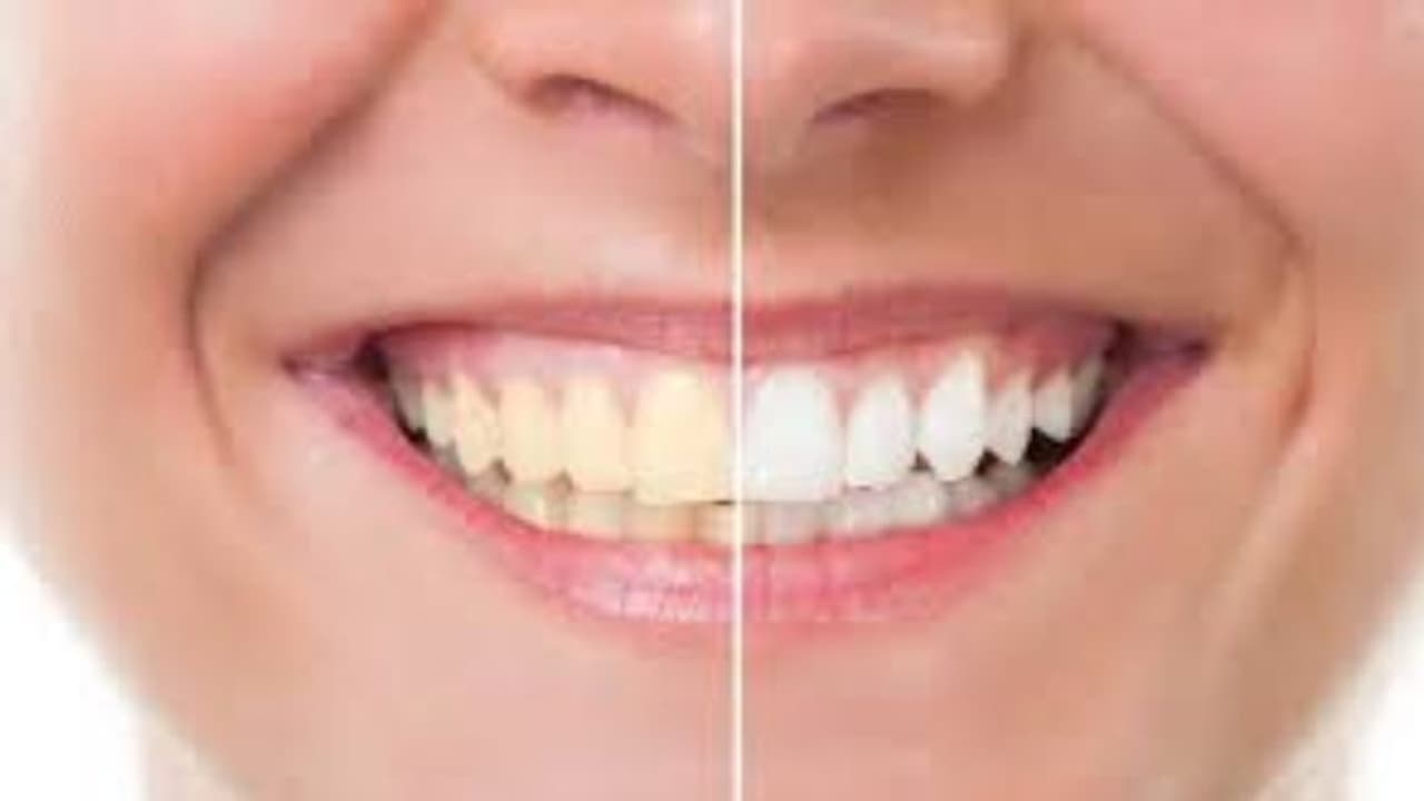 വെറും മൂന്ന് ചേരുവകള്‍ കൊണ്ട് പല്ലുകളുടെ മഞ്ഞ നിറം മാറ്റാം; വീഡിയോ 