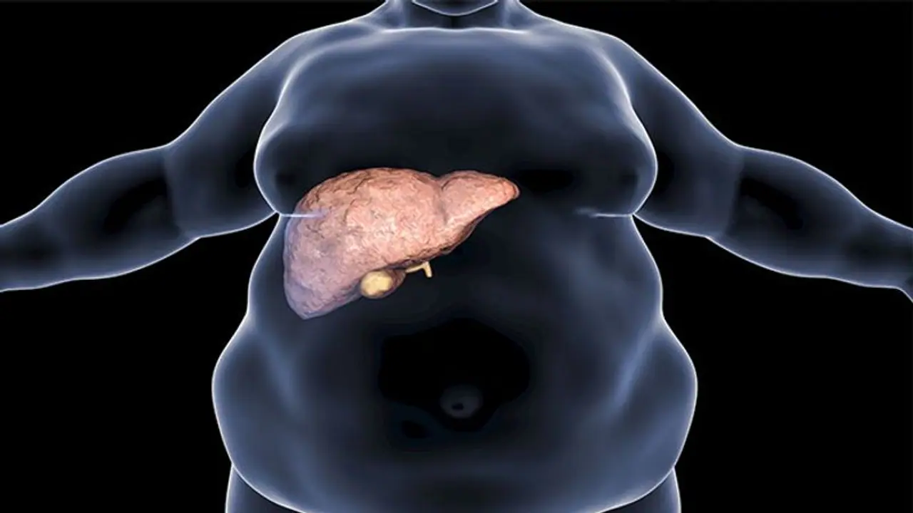 युवाओं में तेजी से बढ़ रही है फैटी लिवर की बीमारी, सुरक्षित रहने के लिए डाइट में करें ये बदलाव युवाओं में तेजी से बढ़ रही है फैटी लिवर की बीमारी, सुरक्षित रहने के लिए डाइट में करें ये बदलाव