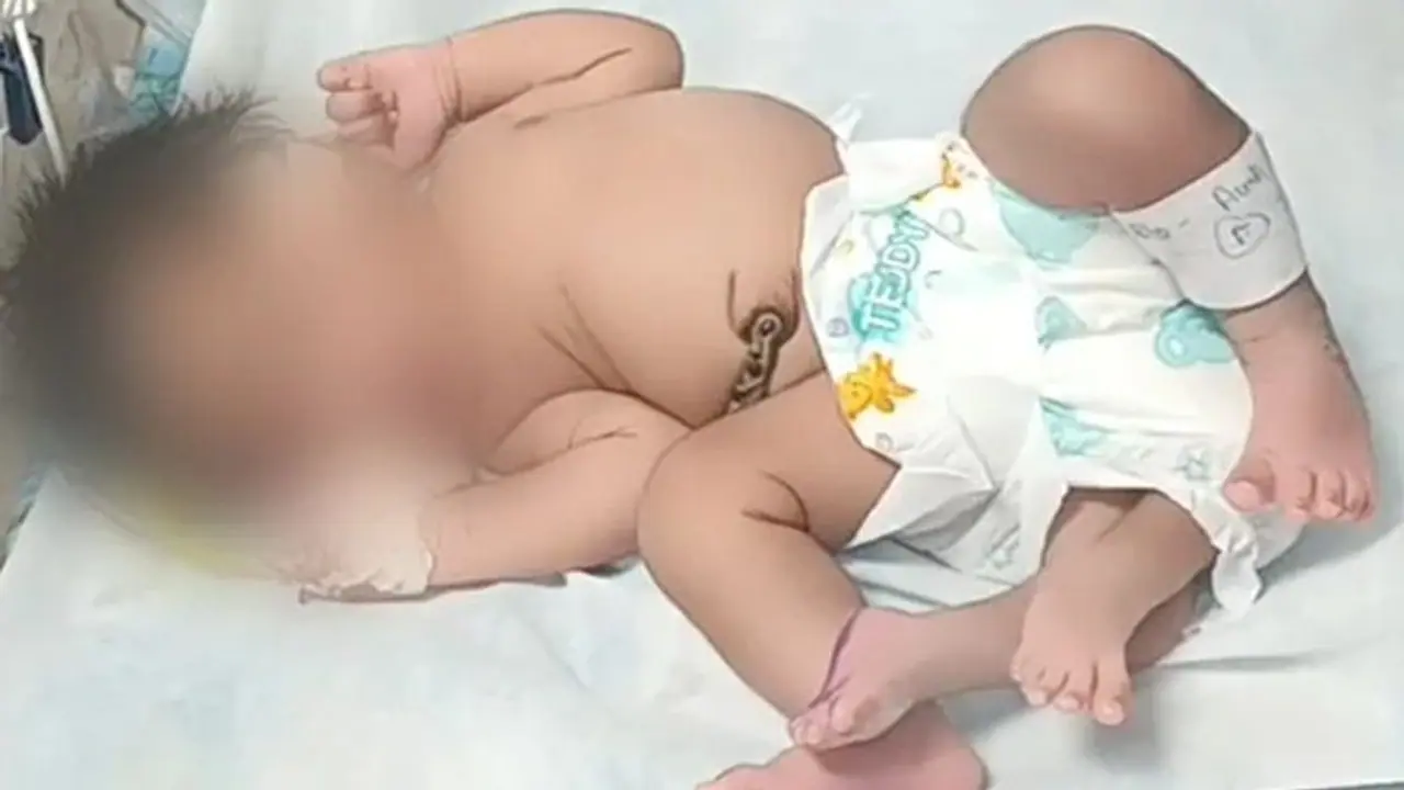 ನಾಲ್ಕು ಕಾಲಿನ ಹೆಣ್ಣು ಮಗು ಜನನ: ಮಧ್ಯಪ್ರದೇಶದಲ್ಲಿ ಅಪರೂಪದ ಪ್ರಕರಣ