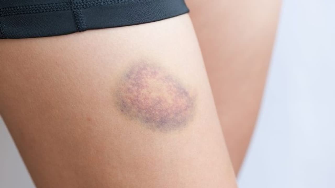 മുറിവുകള്‍ ഉണ്ടാകുമ്പോള്‍ രക്തം പോകുന്നത് നിലയ്ക്കാനും ചതവില്ലാതിരിക്കാനും...