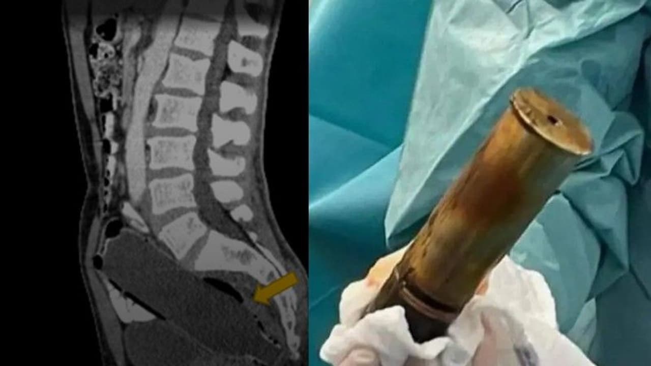 മലദ്വാരത്തില്‍ പീരങ്കി ഷെല്‍ തിരുകിക്കയറ്റി 88 കാരന്‍ 