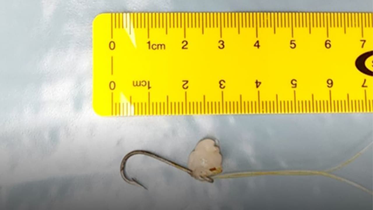 മീന് പിടിക്കുന്നതിനിടെയുണ്ടായ അപകടത്തില് കണ്ണില് കുരുങ്ങിയ ചൂണ്ട ശസ്ത്രക്രിയയിലൂടെ പുറത്തെടുത്തു മീന് പിടിക്കുന്നതിനിടെയുണ്ടായ അപകടത്തില് കണ്ണില് കുരുങ്ങിയ ചൂണ്ട ശസ്ത്രക്രിയയിലൂടെ പുറത്തെടുത്തു