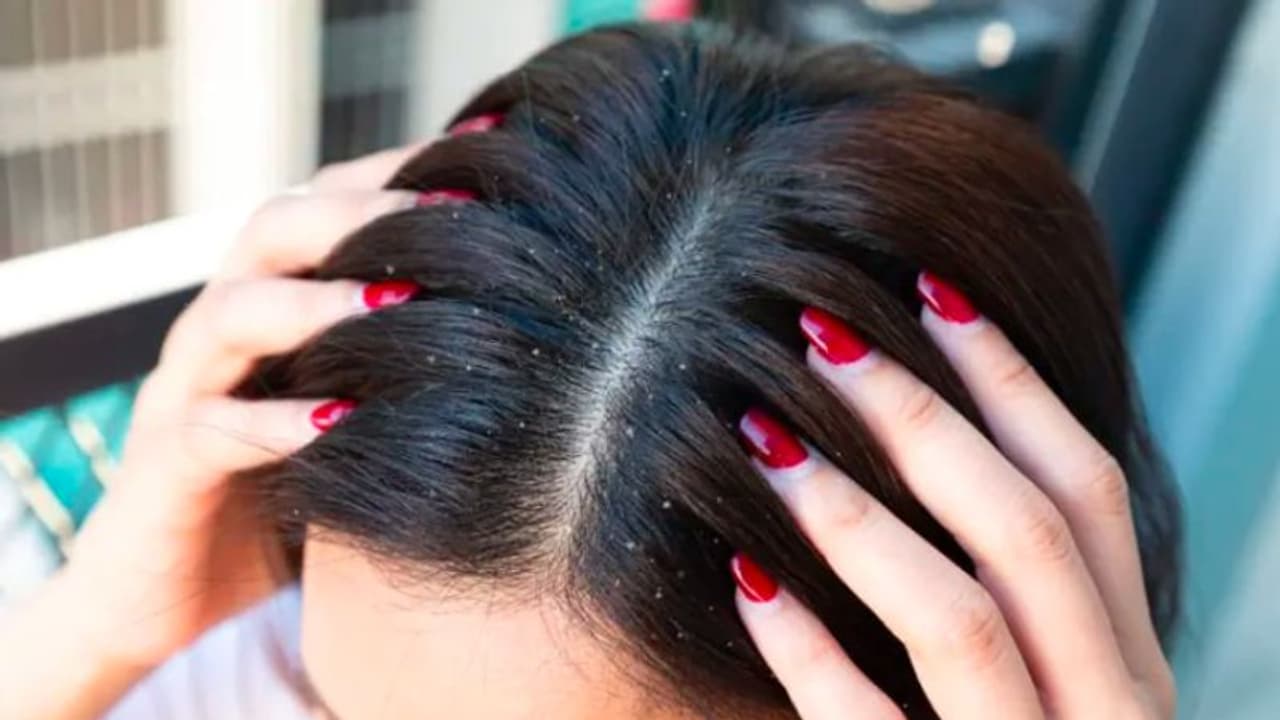 താരൻ അകറ്റാൻ ഇതാ നാല് വഴികൾ... താരൻ അകറ്റാൻ ഇതാ നാല് വഴികൾ...