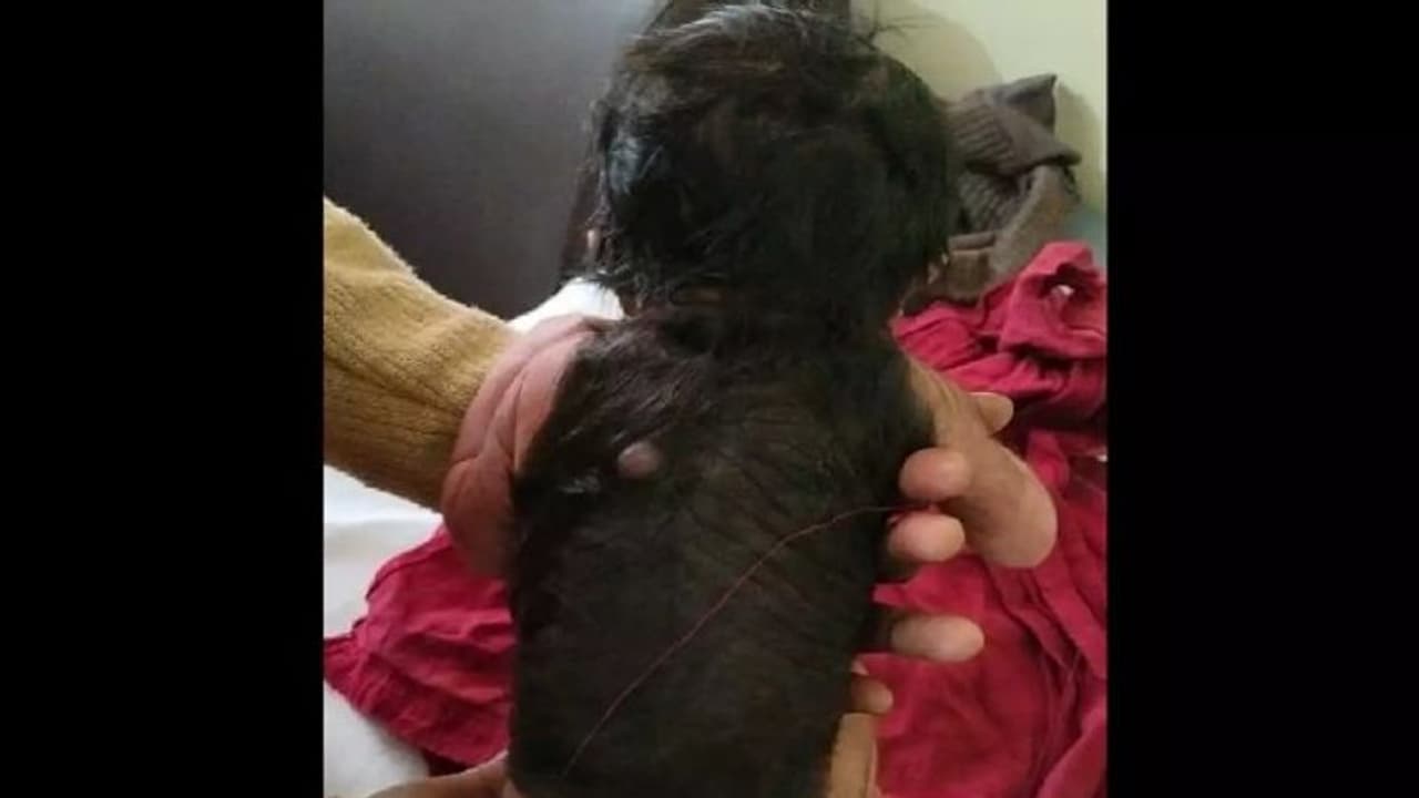 ശരീരത്തിലെ 60 ശതമാനവും മറുകും രോമവുമായി കുഞ്ഞ് പിറന്നു; ഇത് അപൂര്‍വമായ അവസ്ഥ