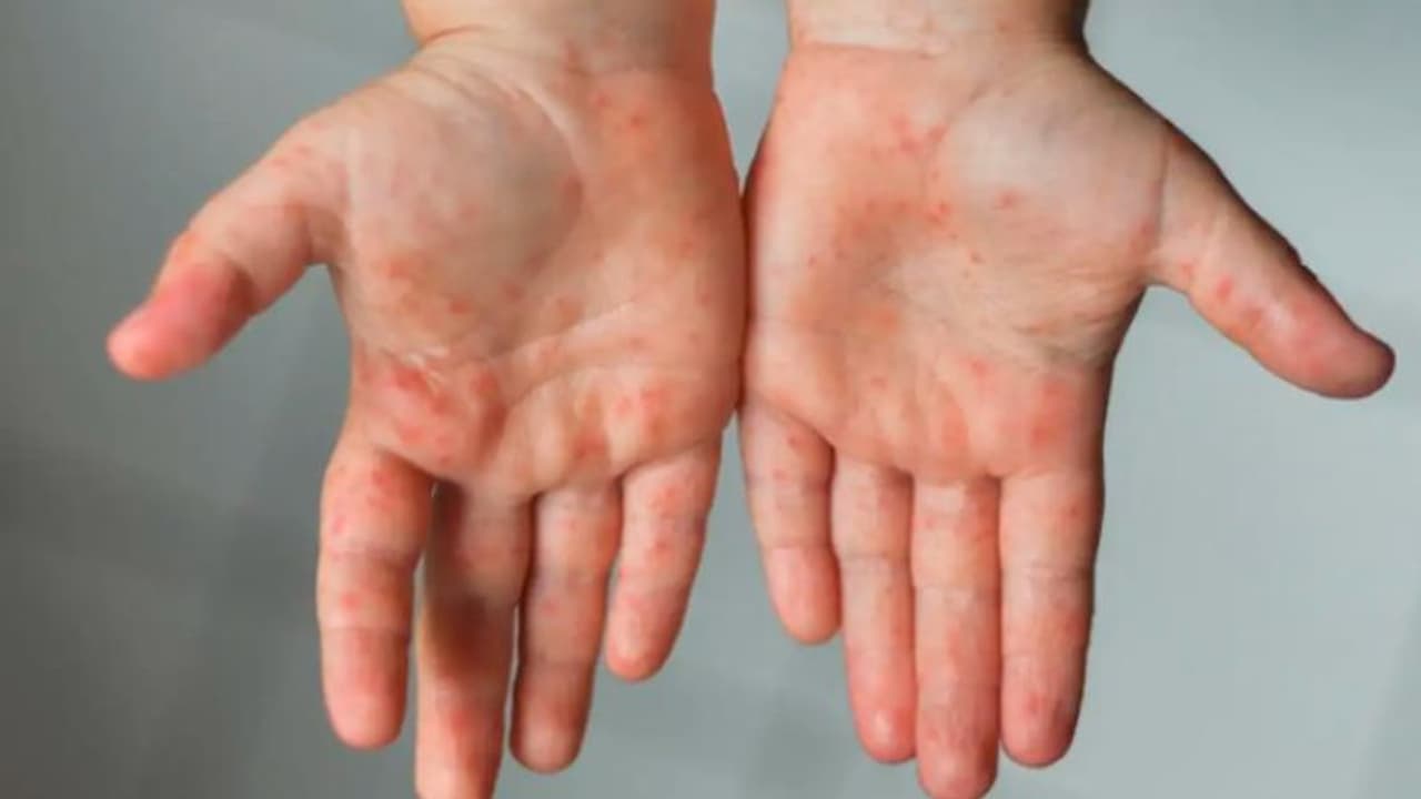 അ‍ഞ്ചാം പനി കേസുകള്‍ ആശങ്ക സൃഷ്ടിക്കുന്നു!; ഭയപ്പെടേണ്ടതുണ്ടോ? 