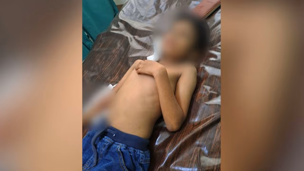 തൃശ്ശൂരിൽ തെരുവ് നായ ആക്രമിച്ചു; ബധിരനായ ഒൻപത് വയസുകാരന് സാരമായി പരിക്കേറ്റു