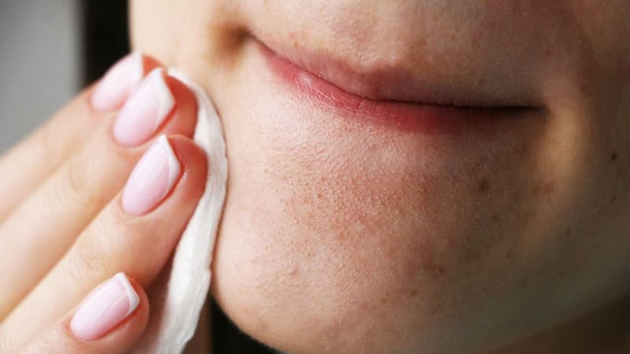 ബ്ലാക്ക്ഹെഡ്‌സ് എങ്ങനെ ഒഴിവാക്കാം? വീട്ടില്‍ പരീക്ഷിക്കാം ഈ ഏഴ് പൊടിക്കൈകള്‍...