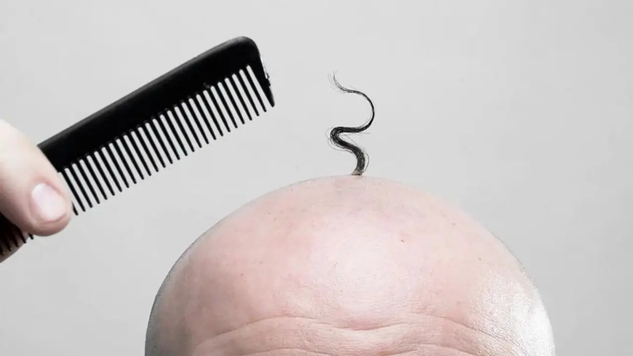 வெளியில் தலைகாட்ட முடியல; எங்களுக்கும் உதவித்தொகை வேண்டும் வழுக்கை சங்கத்தினர் எச்சரிக்கை வெளியில் தலைகாட்ட முடியல; எங்களுக்கும் உதவித்தொகை வேண்டும் வழுக்கை சங்கத்தினர் எச்சரிக்கை