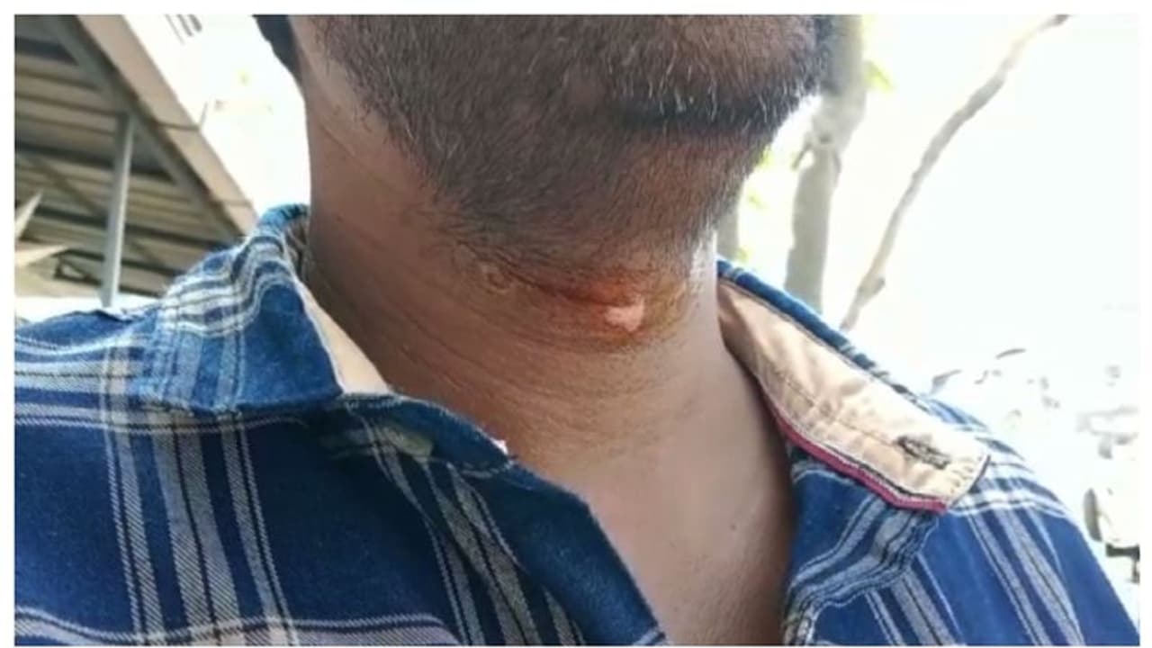 കൊച്ചിൻ കാർണിവലിനായി കെട്ടിയ തോരണം കഴുത്തില് കുടുങ്ങി, ബൈക്ക് യാത്രക്കാരന് പരിക്ക് കൊച്ചിൻ കാർണിവലിനായി കെട്ടിയ തോരണം കഴുത്തില് കുടുങ്ങി, ബൈക്ക് യാത്രക്കാരന് പരിക്ക്