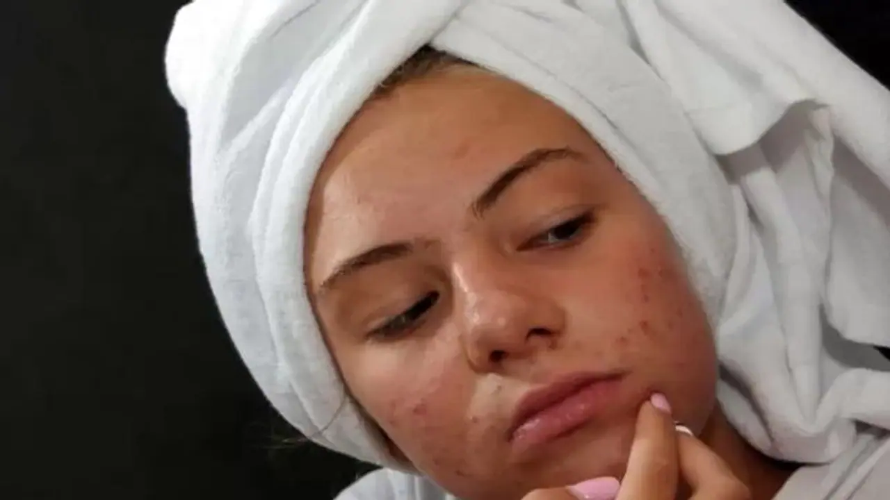 Beauty Tips : ஓரே இரவில் முக பரு மறைய தேங்காய் எண்ணெயுடன் 'இத' கலந்து முகத்தில் தடவினால் போதும்!