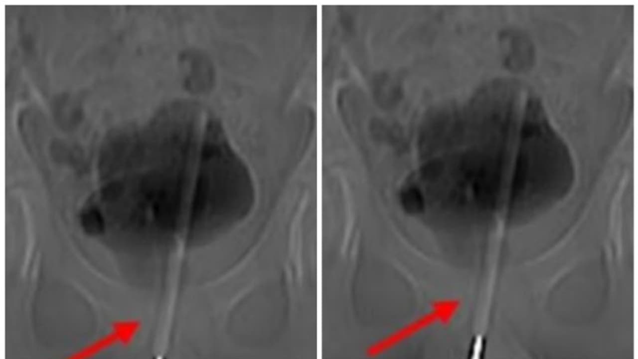 അമ്പരന്ന് ഡോക്ടർമാർ...! 12 വയസ്സുകാരന്റെ മൂത്രാശയത്തിൽ നിന്ന് പുറത്തെടുത്തത് തെർമോമീറ്റർ അമ്പരന്ന് ഡോക്ടർമാർ...! 12 വയസ്സുകാരന്റെ മൂത്രാശയത്തിൽ നിന്ന് പുറത്തെടുത്തത് തെർമോമീറ്റർ
