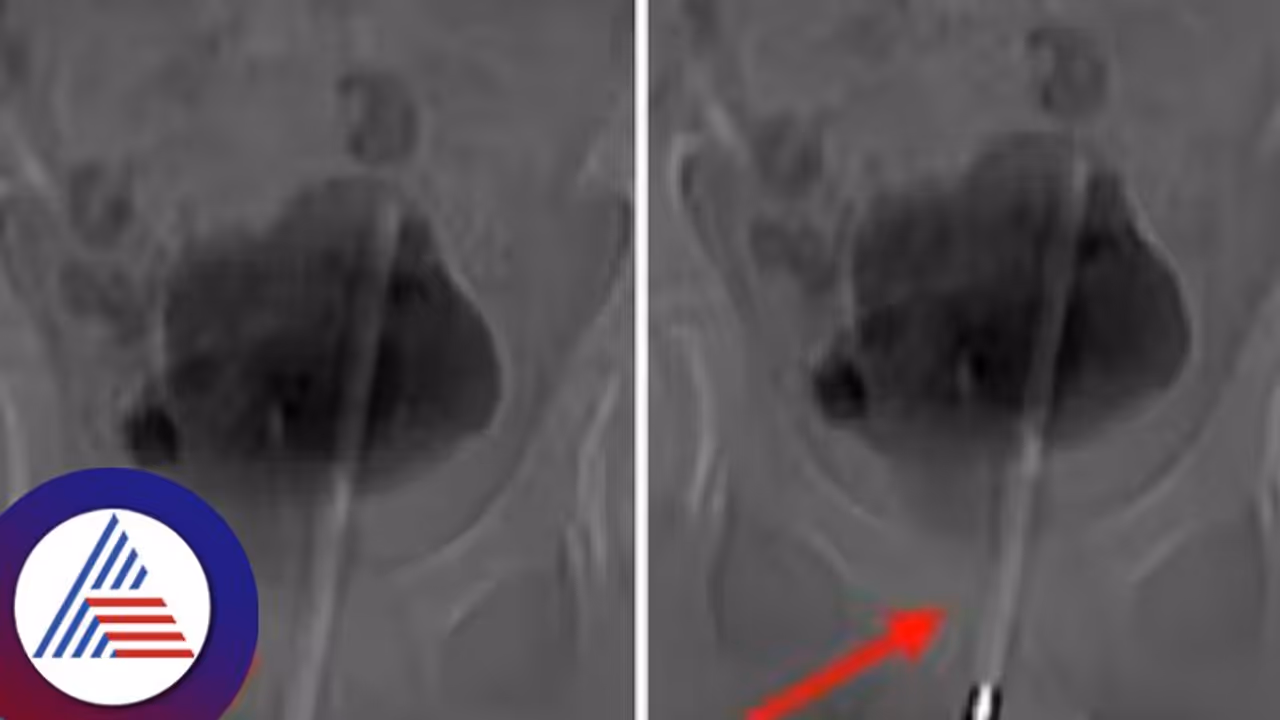 ಅಬ್ಬಬ್ಬಾ..ಬಾಲಕನ ಶಿಶ್ನದಲ್ಲಿ ಸಿಲುಕಿಕೊಂಡಿತ್ತು ಅಷ್ಟುದ್ದದ ಥರ್ಮೋಮೀಟರ್ ! ಅಬ್ಬಬ್ಬಾ..ಬಾಲಕನ ಶಿಶ್ನದಲ್ಲಿ ಸಿಲುಕಿಕೊಂಡಿತ್ತು ಅಷ್ಟುದ್ದದ ಥರ್ಮೋಮೀಟರ್ !