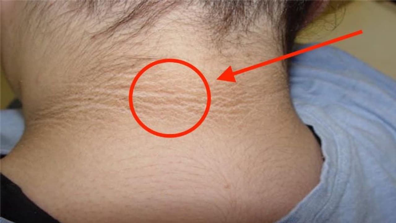 കഴുത്തിലെ കറുത്ത പാടുകള് അകറ്റാം; വീട്ടില് പരീക്ഷിക്കാം ഇക്കാര്യങ്ങള്... കഴുത്തിലെ കറുത്ത പാടുകള് അകറ്റാം; വീട്ടില് പരീക്ഷിക്കാം ഇക്കാര്യങ്ങള്...