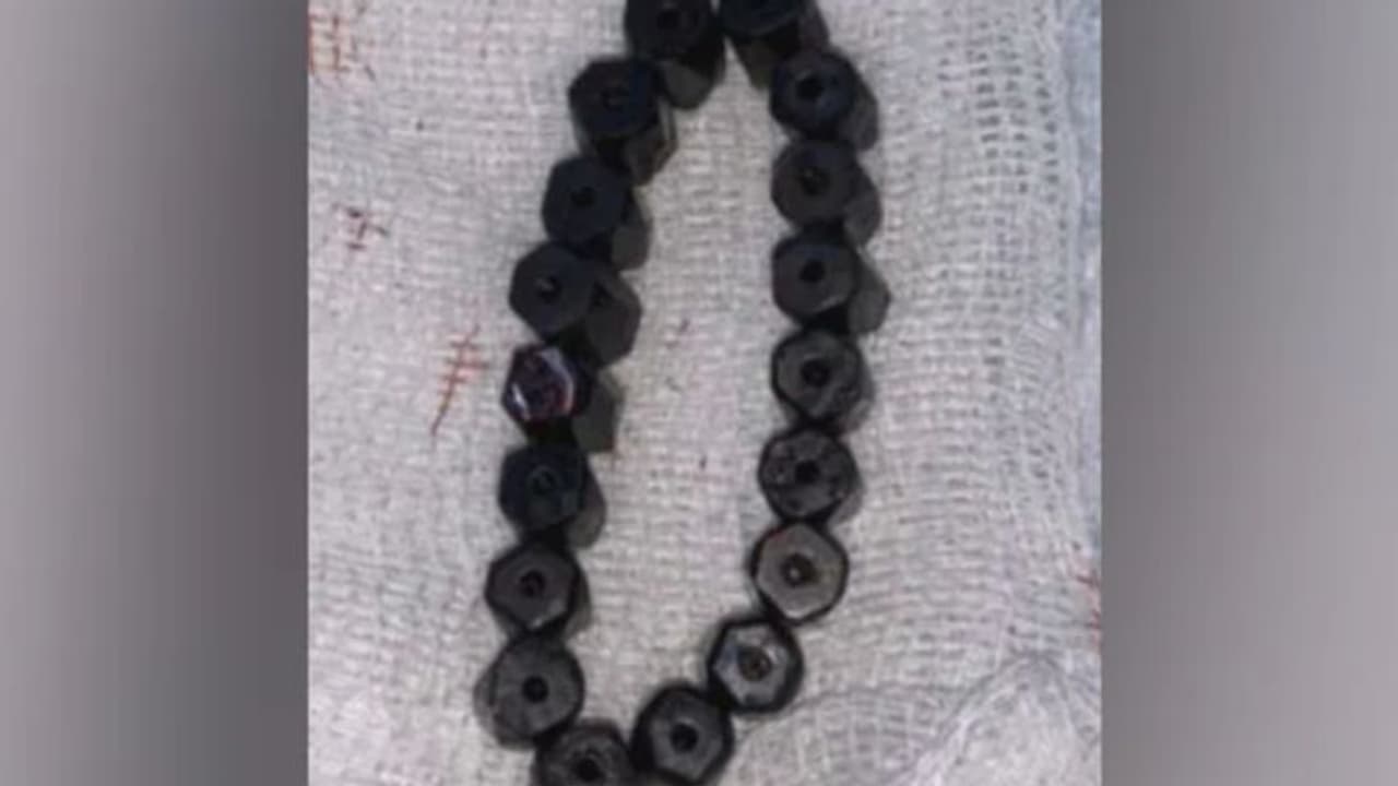 കഠിനമായ വയറുവേദന; നാല് വയസുകാരന്റെ വയറില് നിന്ന് നീക്കം ചെയ്തത് മാഗ്നറ്റിക് ബ്രേസ്ലെറ്റ് കഠിനമായ വയറുവേദന; നാല് വയസുകാരന്റെ വയറില് നിന്ന് നീക്കം ചെയ്തത് മാഗ്നറ്റിക് ബ്രേസ്ലെറ്റ്