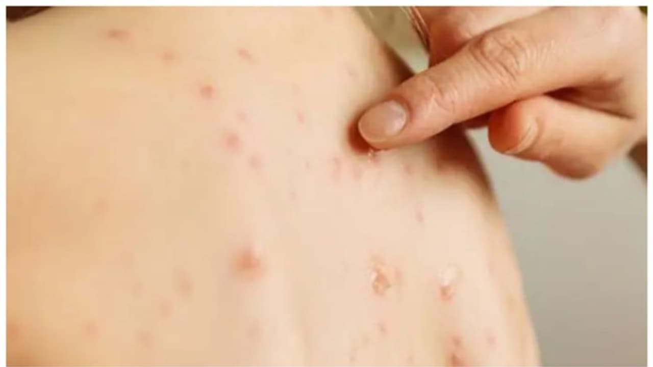 Pakistan: 17 children die from Measles in Sindh over two months amid rising cases Pakistan: 17 children die from Measles in Sindh over two months amid rising cases