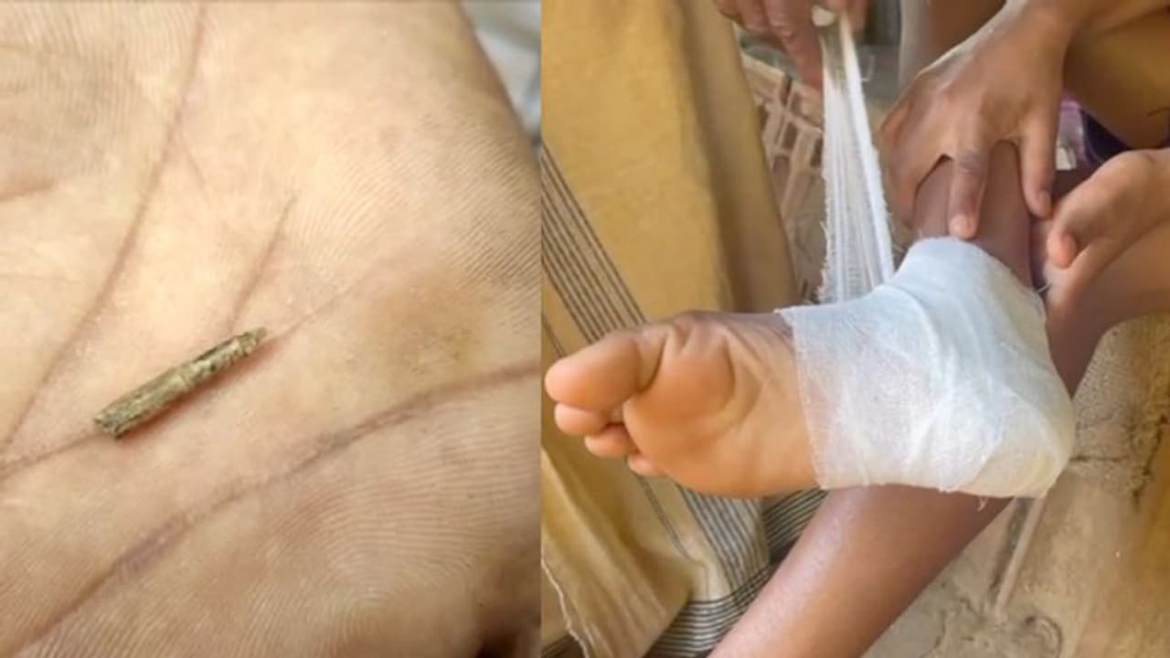 കാലില് തറച്ച മുള്ള് നീക്കാനായി ശസ്ത്രക്രിയ അടക്കം ചികിത്സ; വേദന മാറാതെ വന്നതോടെ മുള്ള് നീക്കി പിതാവ് കാലില് തറച്ച മുള്ള് നീക്കാനായി ശസ്ത്രക്രിയ അടക്കം ചികിത്സ; വേദന മാറാതെ വന്നതോടെ മുള്ള് നീക്കി പിതാവ്