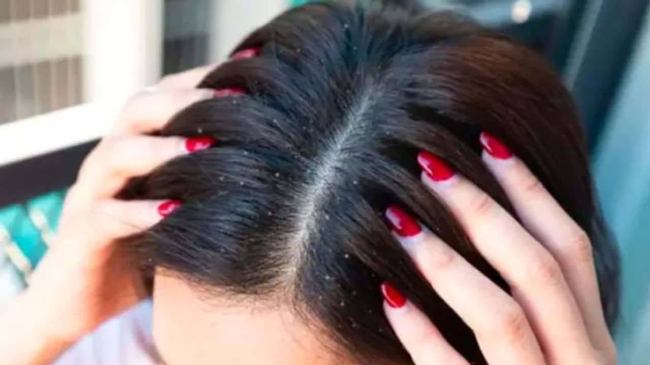 താരൻ അകറ്റാൻ ഈ രണ്ട് ചേരുവകൾ ഉപയോ​ഗിക്കാറുണ്ടോ? എങ്കിൽ ശ്രദ്ധിക്കൂ 