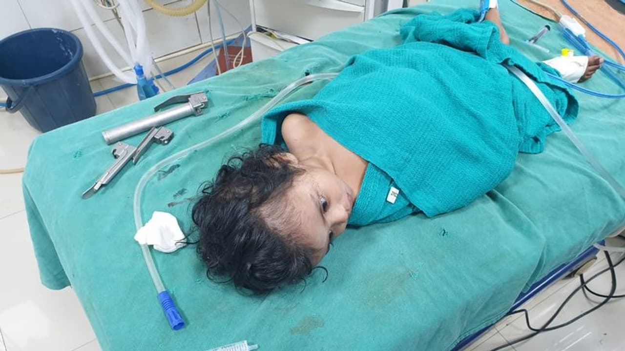 கோவையில் குழந்தையின் மூச்சுக்குழாயில் துகள்; வெற்றிகரமாக அகற்றி அரசு மருத்துவர்கள் அசத்தல்