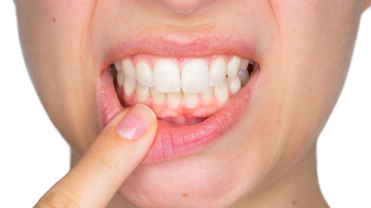 മോണരോഗവും ഹൃദ്രോഗവും തമ്മിൽ ബന്ധമുണ്ടോ? പുതിയ പഠനം പറയുന്നത് മോണരോഗവും ഹൃദ്രോഗവും തമ്മിൽ ബന്ധമുണ്ടോ? പുതിയ പഠനം പറയുന്നത്