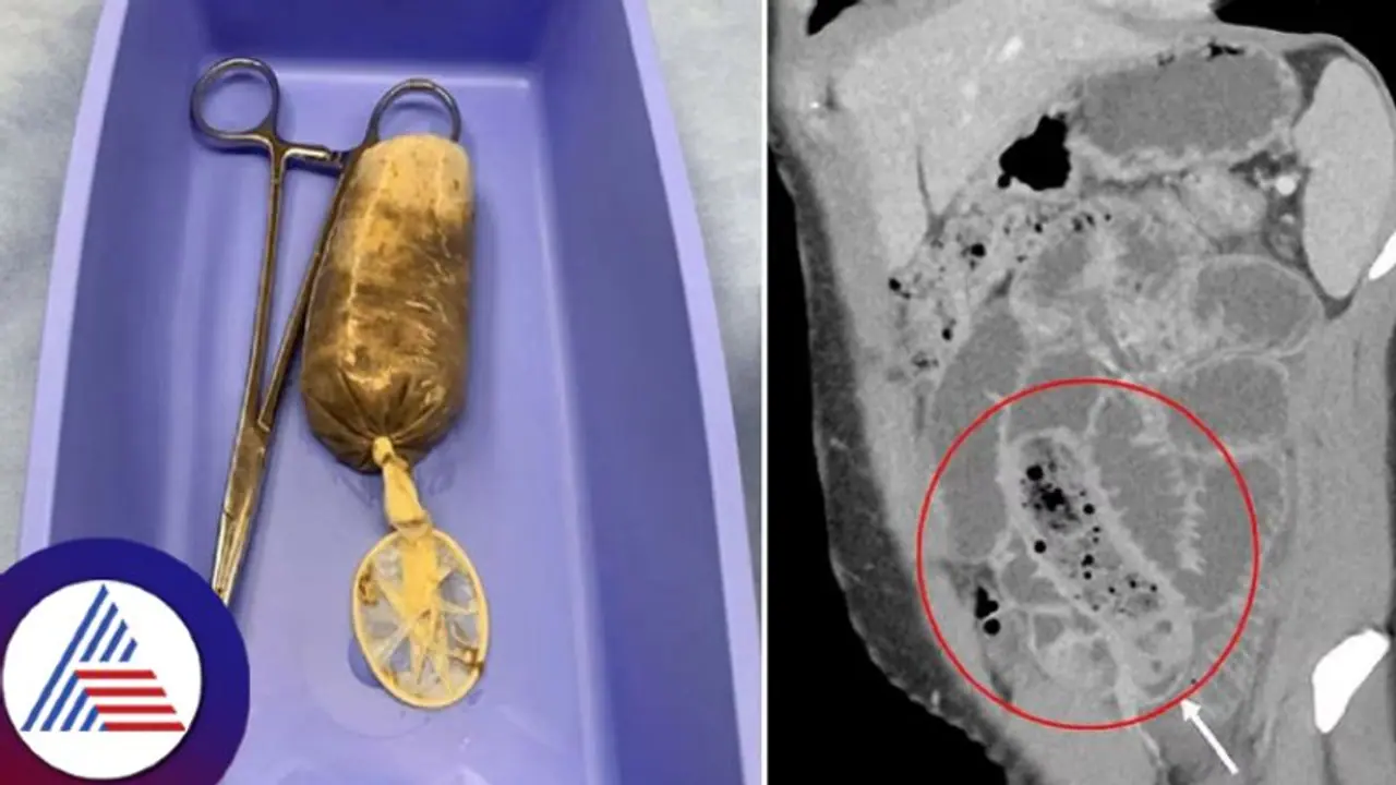 ಅಬ್ಬಾ..ಹೀಗೂ ಮಾಡ್ತಾರಾ..ಕೋಪದಲ್ಲಿ ಕಾಂಡೋಮ್ನಲ್ಲಿ ಸುತ್ತಿದ್ದ ಬಾಳೆಹಣ್ಣು ತಿಂದ! ಅಬ್ಬಾ..ಹೀಗೂ ಮಾಡ್ತಾರಾ..ಕೋಪದಲ್ಲಿ ಕಾಂಡೋಮ್ನಲ್ಲಿ ಸುತ್ತಿದ್ದ ಬಾಳೆಹಣ್ಣು ತಿಂದ!