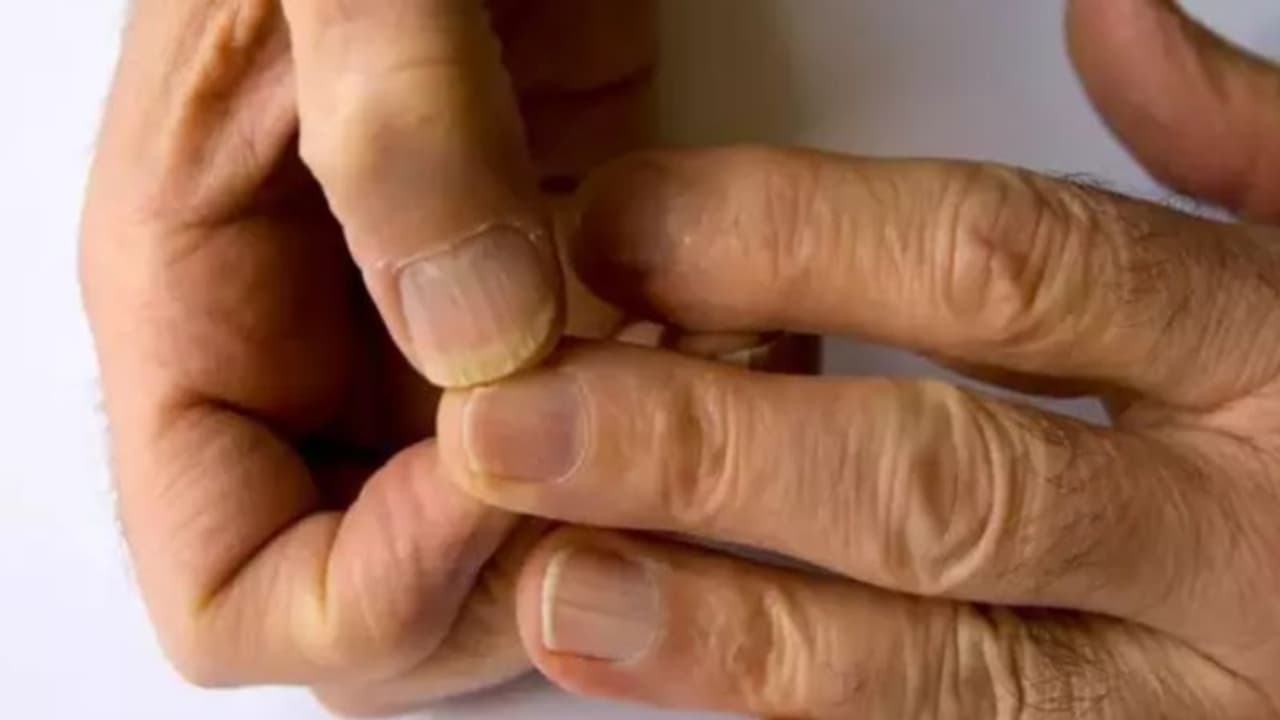 തൊലിപ്പുറത്ത് വരുന്ന തടിപ്പ് മുതല്‍ നിറം മങ്ങിയ നഖങ്ങള്‍ വരെ; അറിയാം കൊളസ്‌ട്രോളിന്‍റെ ലക്ഷണങ്ങള്‍... 