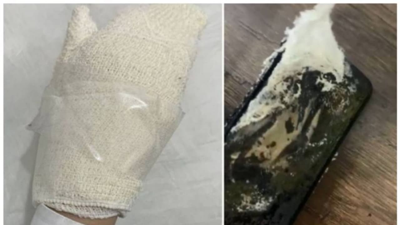 കൈയിലിരുന്ന മൊബൈല് ഫോൺ പൊട്ടിത്തെറിച്ച് 13 വയസുകാരിക്ക് പൊള്ളലേറ്റു കൈയിലിരുന്ന മൊബൈല് ഫോൺ പൊട്ടിത്തെറിച്ച് 13 വയസുകാരിക്ക് പൊള്ളലേറ്റു