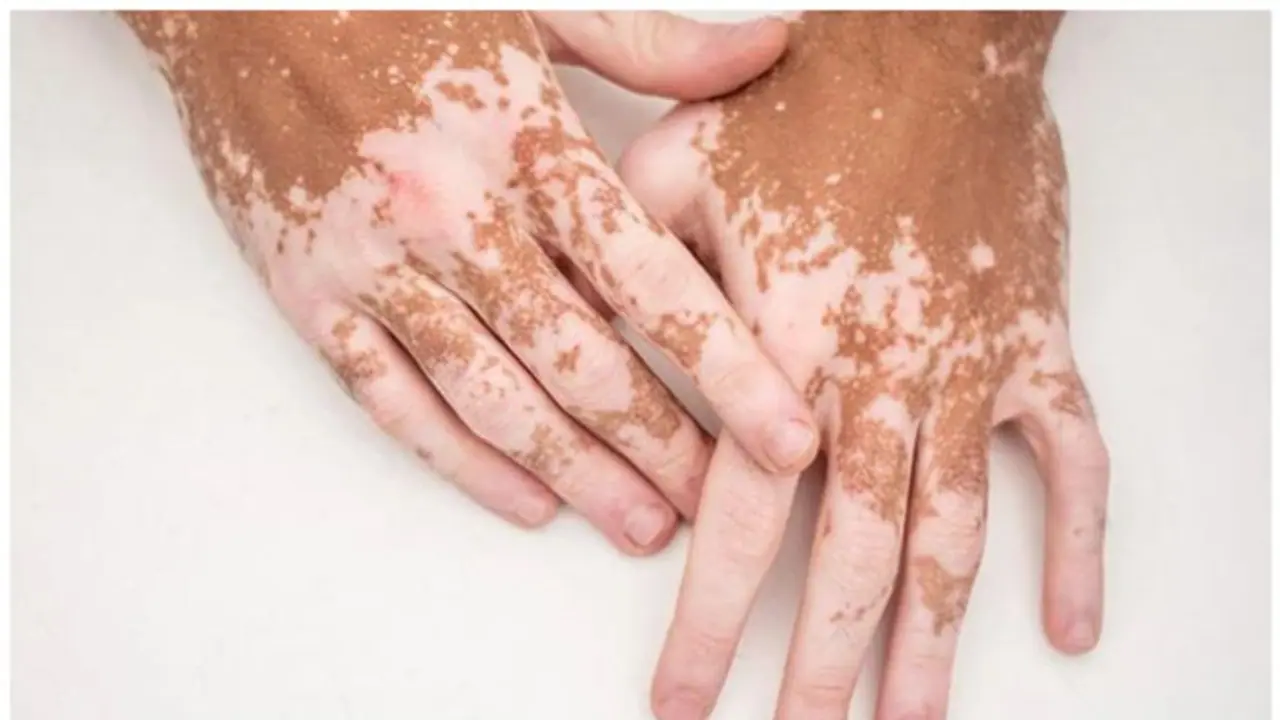 Vitiligo: బొల్లి వ్యాధికి కారణాలు ఇవే.. నిర్లక్ష్యం చేస్తే సమస్యలు తప్పవు? Vitiligo: బొల్లి వ్యాధికి కారణాలు ఇవే.. నిర్లక్ష్యం చేస్తే సమస్యలు తప్పవు?