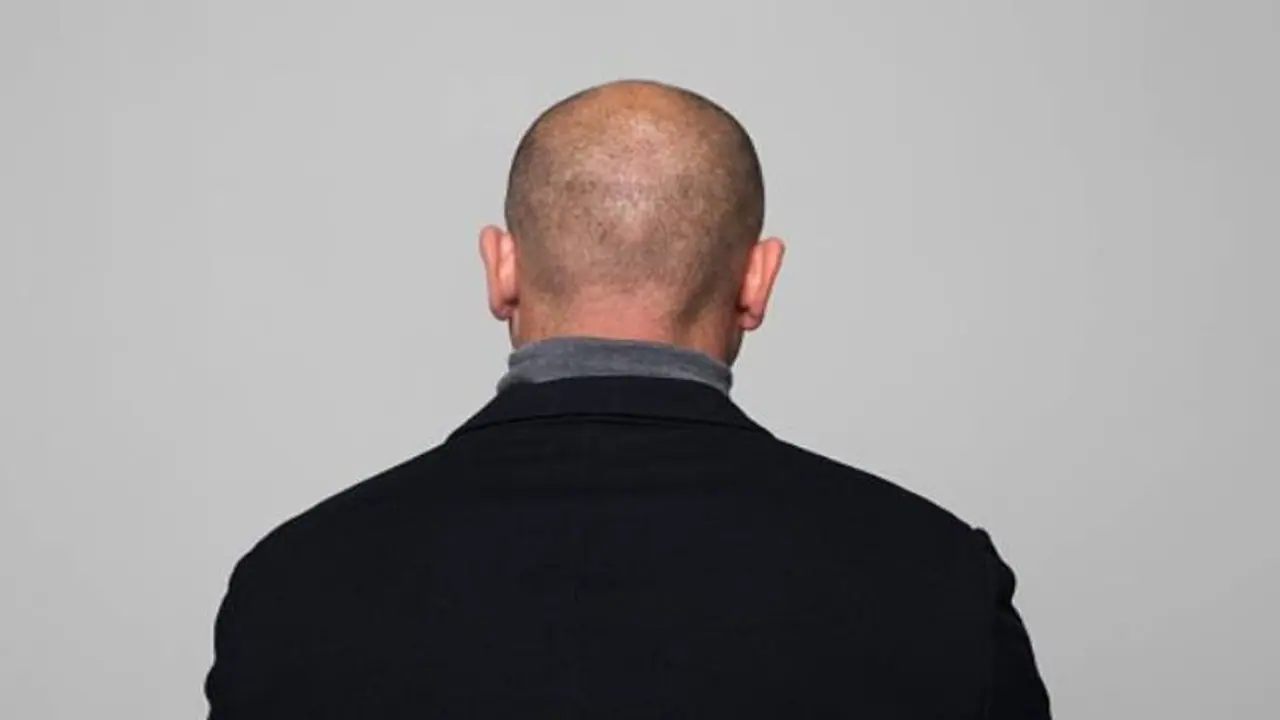 തല മൊട്ടയായതിനാൽ രാജി വെപ്പിച്ചു, 70 ലക്ഷം നഷ്ടപരിഹാരം! തല മൊട്ടയായതിനാൽ രാജി വെപ്പിച്ചു, 70 ലക്ഷം നഷ്ടപരിഹാരം!