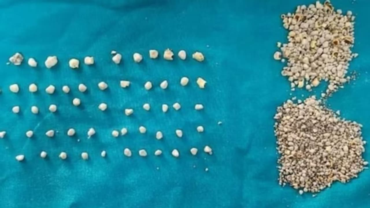 പ്രമേഹരോഗിയായ സ്ത്രീയുടെ പിത്താശയത്തില്‍ നിന്ന് നീക്കം ചെയ്തത് 1200 കല്ല്!